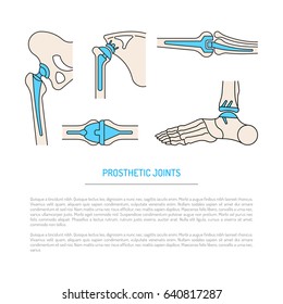 Vector banner on the theme of health, the health of human joints and methods of operative treatment by implantation. Vector illustration with place for text, isolated on white background