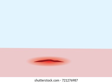 vector of bleeding wound on the skin