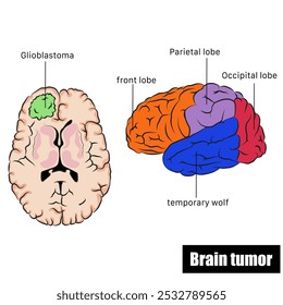 Tumor cerebral vetorial, também chamado câncer cerebral.	