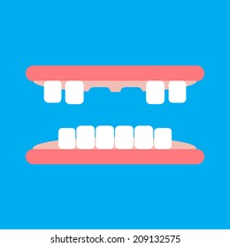 Vector of broken tooth model on blue background. Cartoon illustration. 