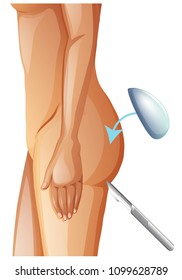 A Vector of Buttock Augmentation illustration