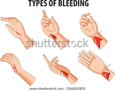 Vector cartoon illustration comparing various types of bleeding on human arms