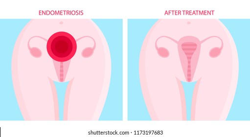 Vector cartoon illustration of the female uterus endometriosis 