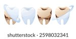Vector cartoon isolated illustration set of clean and decayed teeth before and after treatment. Dental hygiene, oral care, cavity prevention for dentistry, medical infographics, and healthcare.