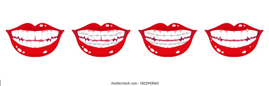 Vector cartoon set of smiling mouths with stages of teeth alignment using orthodontic metal braces on a white background. Dental concept.