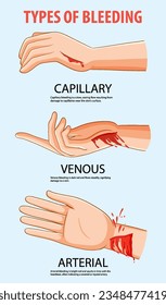 Caricatura vectorial que muestra hemorragia en capilares, venas y arterias