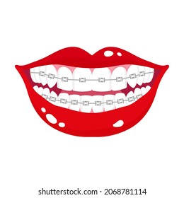 Vector cartoon smiling mouth with stages of teeth alignment using orthodontic metal braces. Dental concept.