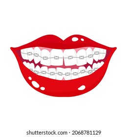 Vector cartoon smiling mouth with stages of crooked teeth alignment using orthodontic metal braces. Dental concept.