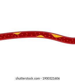 vector de diseño ilustrativo de placa de colesterol 