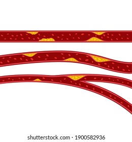 Vektorgrafik von Cholesterin-Plaque-Illustrationen 