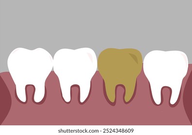 Vector Limpie los dientes sanos con las encías inflamadas. Problemas Orales Dentales Médicos. Limpieza del esmalte. Aislado sobre fondo gris. Enfermedad de las encías dentales humanas Ilustración vectorial