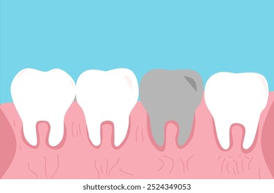 Vetor Limpar Dentes Saudáveis com Gengivas Inflamadas. Problemas Orais Médicos. Limpeza do esmalte. Isolado no fundo azul. Ilustração do vetor da doença da gengiva dentária humana