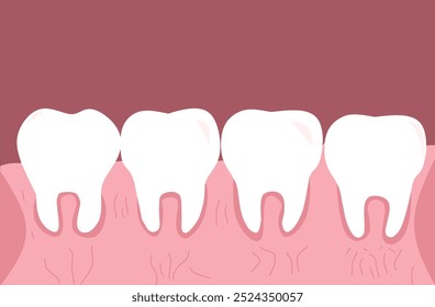 Vector Limpie los dientes sanos con las encías inflamadas. Problemas Orales Dentales Médicos. Limpieza del esmalte. Aislado sobre fondo rojo oscuro. Enfermedad de las encías dentales humanas Ilustración vectorial