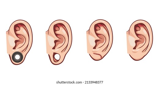 Vector color illustration of ear with tunnel, stretched piercing. Earlobe after flesh tunnel repair isolated on white