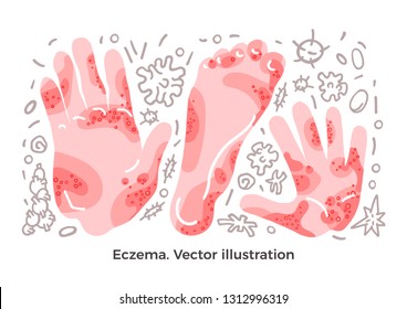 Vector color set Eczema, illness symptom, bacteria and methods of treatment Skin rashes on arm, leg, hand Art drawn illustration on white background Design concept for medicine poster Element isolated