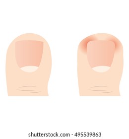 Vector of Common Foot Problems. ingrown nail