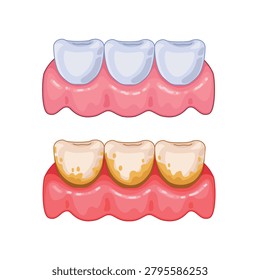 Vector comparison of healthy clean teeth and teeth with plaque buildup along the gumline.