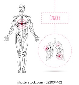 Vector concept white and black human anatomy with Lungs disease - tuberculosis, cancer illustration for medical poster