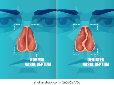 Vector cross section of human face with deviated and normal nasal septum 