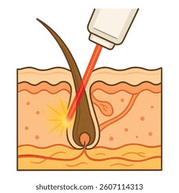 Vector cross sectional illustration of human skin during laser hair removal. The image shows epidermis, dermis and subcutaneous layers, with a hair follicle. Isolated design on white background.