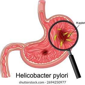 Vector de sección transversal del estómago con Helicobacter pylori magnificado, etiquetado claro, colores brillantes