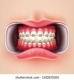 Vector dental braces installation, realistic brakets system in mouth. Teeth care, dentist medical concept. Oral hygiene, orthodontics treatment. Healthcare, correct bite