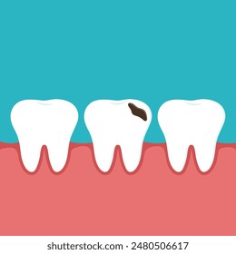 Vektorgrafik Zahnärztliche Darstellung eines gesunden Zahnes und eines Zahnes mit Karies und einem Zahnfleischloch. 