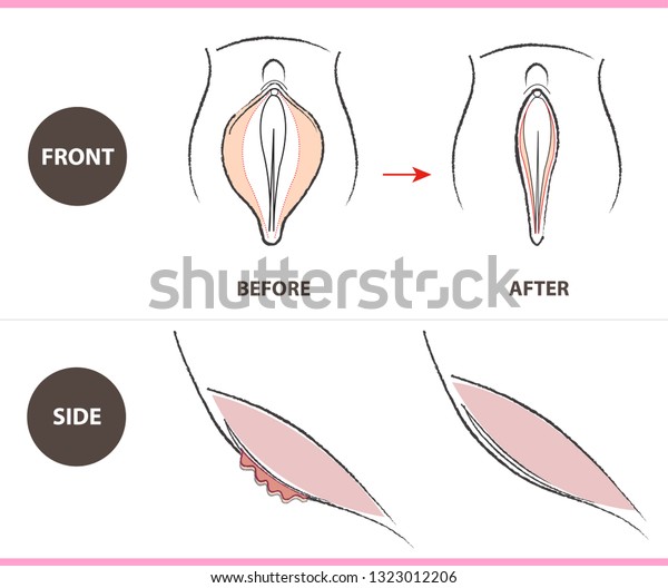 女性の性器 膣形成術 唇形成術 前面側面としてのベクター画像デザイン のベクター画像素材 ロイヤリティフリー