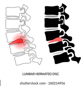 Vector design of human vertebra disc hernia lateral view 