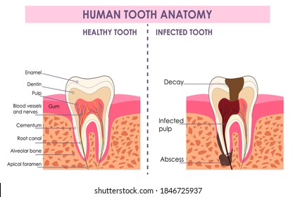 Vector detailed scientific scheme of dental structure build. Comparison of healthy and infected human tooth anatomy. Educational info graphic dental poster. Medical treatment toothache cause infection