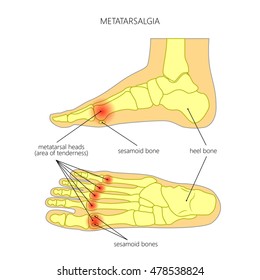 Vector diagram of forefoot pain, metatarsalgia symptom, tenderness in the balls of metatarsal bones of the foot. Used: Gradient, transparency, blend mode.