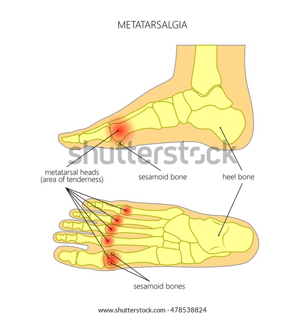 Vector Diagram Forefoot Pain Metatarsalgia Symptom庫存向量圖 免版稅 478538824