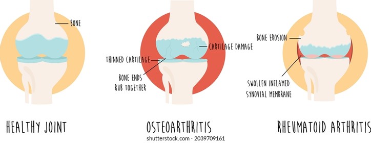 Vector diagram with healthy joint and joint with osteoarthritis, rheumatoid arthritis. Medical poster, design