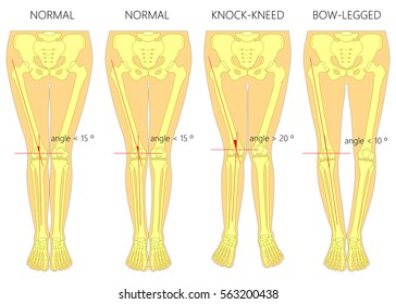 Vector Diagram. Shapes Of The  Legs. Normal And Curved Legs.Knock Knees. Bowed Legs. Genu Valgum And Genu Varum.