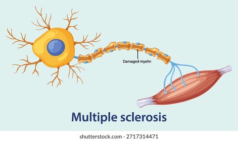 El diagrama de Vector muestra una neurona con vaina de mielina dañada que se conecta a las fibras musculares, lo que destaca la degeneración nerviosa en la esclerosis múltiple. Estilo limpio y educativo