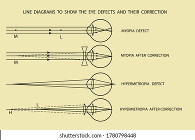 vector diagrams to show different types of eye defects