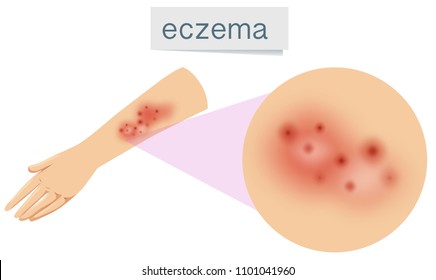 A Vector of Eczema on Skin illustration