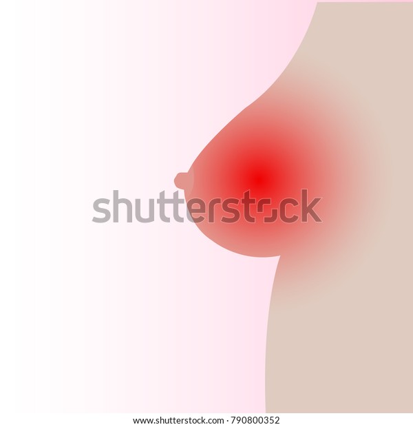 Vector Female Breast Red Spot Showing Stock Vector Royalty Free