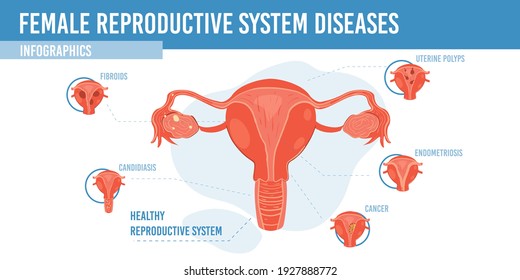 Vector Flat Cartoon Infographichealthy Female Reproductive Stock Vector ...