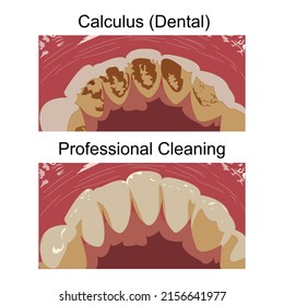 Vector flat design of heavy staining and calculus deposits exhibited on the lingual surface of the mandibular anterior teeth ,along the gum line are signs that needs professional cleaning from dentist