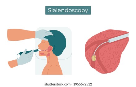 Vector flat illustration of sialendoscopy. Surgery to remove a stone from the duct of the parotid salivary gland.