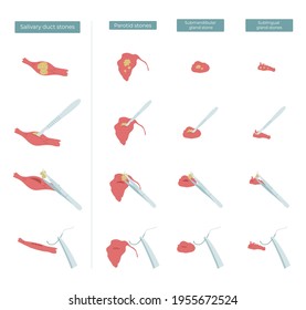 Vector flat illustration of surgery to remove stones from the parotid, submandibular and sublingual salivary glands.