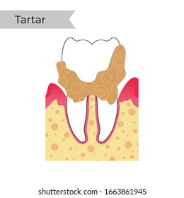 Vector flat isolated illustration of dental calculus, calcified plaque, tartar. Teeth anatomy infographics. Medical banner or poster illustration. Dental problem.