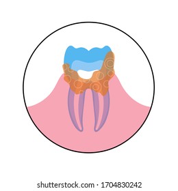 Vector flat isolated illustration of dental calculus, calcified plaque, tartar. Teeth anatomy infographics. Medical banner or poster illustration. Dental problem.