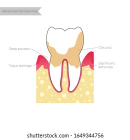 Vector de ilustración aislada de la periodontitis. Infografías sobre anatomía dental. Cartel médico o ilustración del afiche. Problema dental. Salud Oral Médica. Plantilla de la enfermedad periodontal 