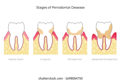 Vector flat isolated illustration of periodontitis. Tooth anatomy infographics. Medical banner or poster illustration. Dental problem. Medical Oral Health. Template of Periodontal Disease 