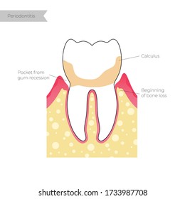 Vector flat isolated illustration of periodontitis. Tooth anatomy infographics. Medical banner or poster illustration. Dental problem. Medical Oral Health. Template of Periodontal Disease