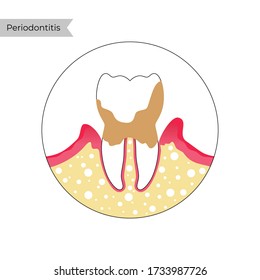 Vector flat isolated illustration of periodontitis. Tooth anatomy infographics. Medical banner or poster illustration. Dental problem. Medical Oral Health. Template of Periodontal Disease