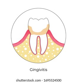 Vector flat isolated illustration of tooth with gingivitis. Teeth anatomy infographics. Medical banner or poster illustration. Dental problem. Medical Oral Health. Template of Periodontal Disease 