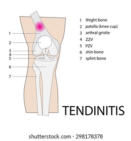 vector format illustration of tendinitis knee injury